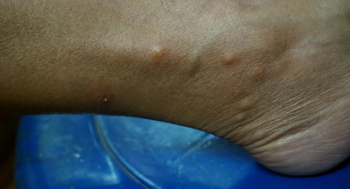 Bed bug bites on an ankle