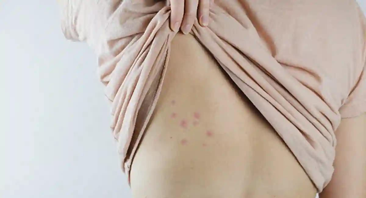 Flea bites