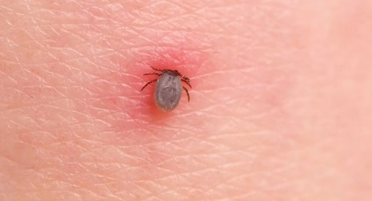 Irritated, red human skin with a tick latched on