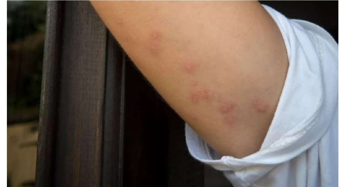 Bed bug bite on neck
