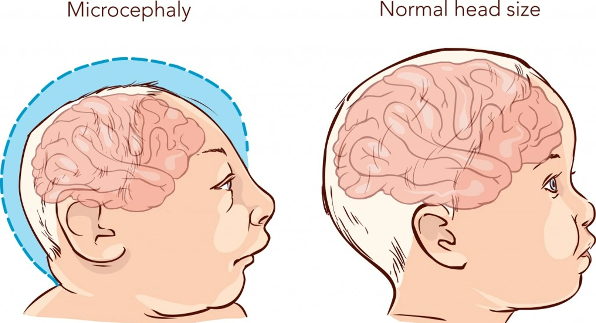 microcephaly